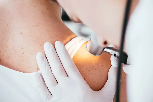 Ärztin untersucht ein Muttermal mit dem Dermatoskop